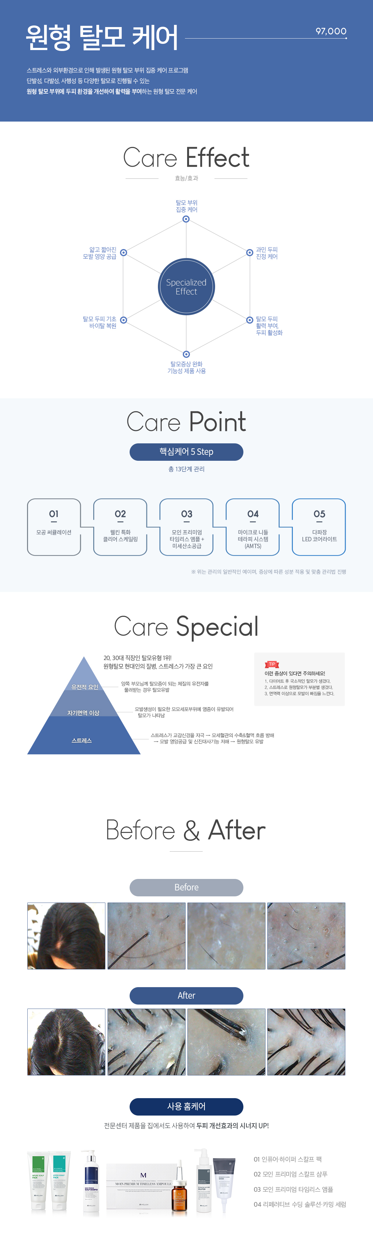원형 탈모 케어